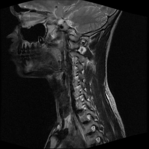 File:Carotid body tumor (Radiopaedia 30208-30823 Sagittal T2 8).jpg