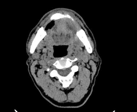 Carotid body tumor (Radiopaedia 61750-69757 Axial non-contrast 35).jpg