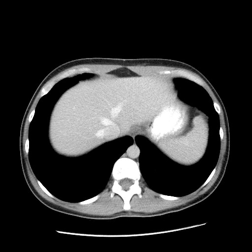 Castleman disease with fibrous pseudotumor in the abdomen (Radiopaedia 77296-89373 A 17).jpg