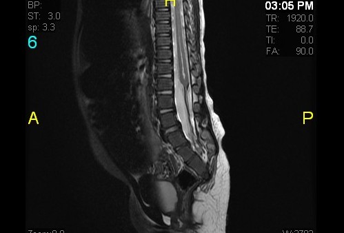 File:Caudal regression syndrome (Radiopaedia 16824-16544 T2 1).jpg