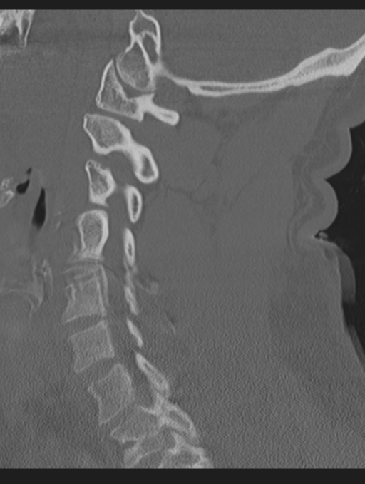 Cavernoma of cervical cord (Radiopaedia 50838-56346 Sagittal bone window 50).png