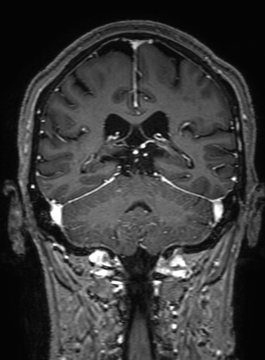 Cavernous hemangioma of the cerebellar falx (Radiopaedia 73025-83724 Coronal T1 C+ 245).jpg