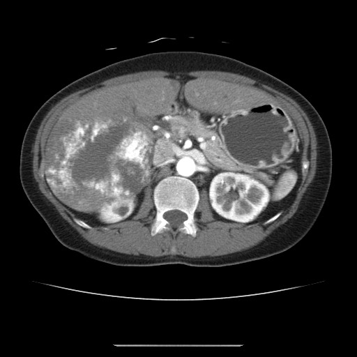 Cavernous hepatic hemangioma (Radiopaedia 75441-86667 A 40).jpg
