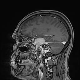 Cavernous sinus meningioma (Radiopaedia 63682-72367 Sagittal T1 C+ 64).jpg