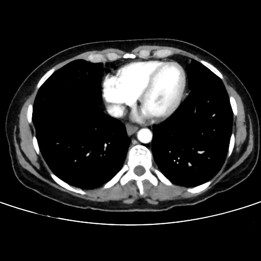 File:Cavitating lung mass - squamous cell carcinoma (Radiopaedia 48047-52854 B 34).png