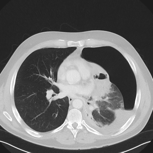 File:Cavitating pneumonia complicated by pneumothorax (Radiopaedia 48149-52994 Axial lung window 38).png
