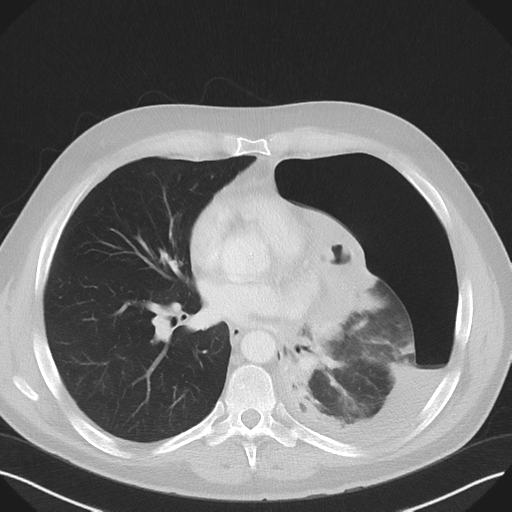 Cavitating pneumonia complicated by pneumothorax (Radiopaedia 48149-52994 Axial lung window 39).png