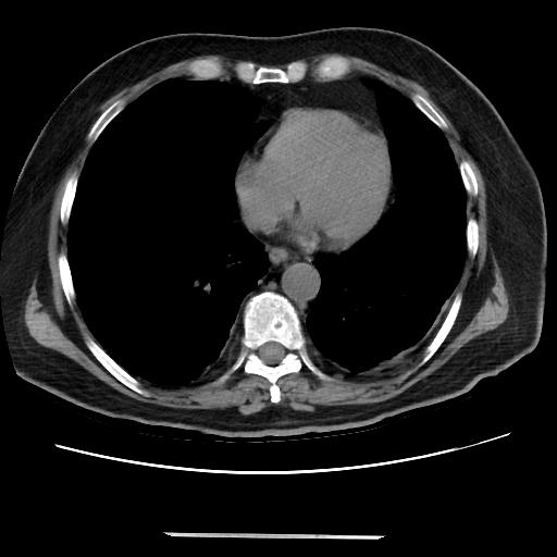Cavitating pulmonary metastases (Radiopaedia 89545-106544 Axial non-contrast 38).jpg