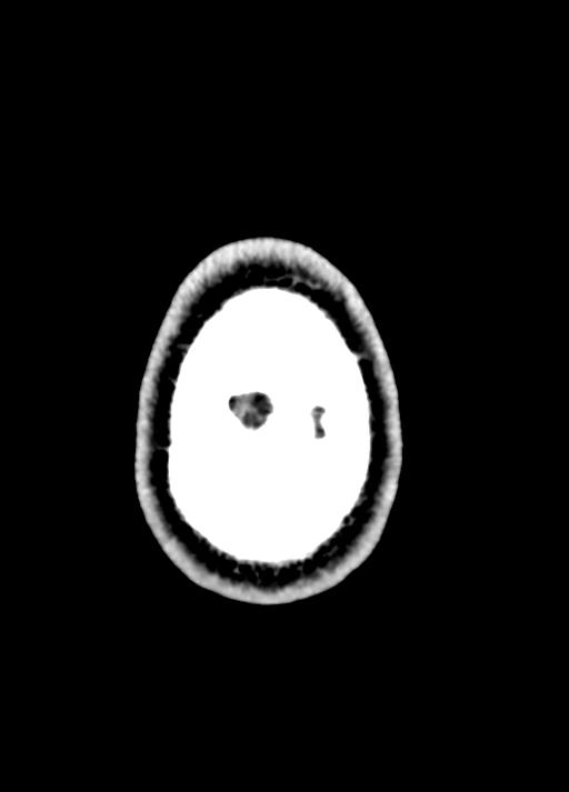 Cavum septum pellucidum and cavum vergae (Radiopaedia 77797-90060 Axial Brain Window 103).jpg
