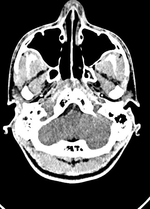 Cavum septum pellucidum and cavum vergae (Radiopaedia 77797-90060 Axial Brain Window 15).jpg