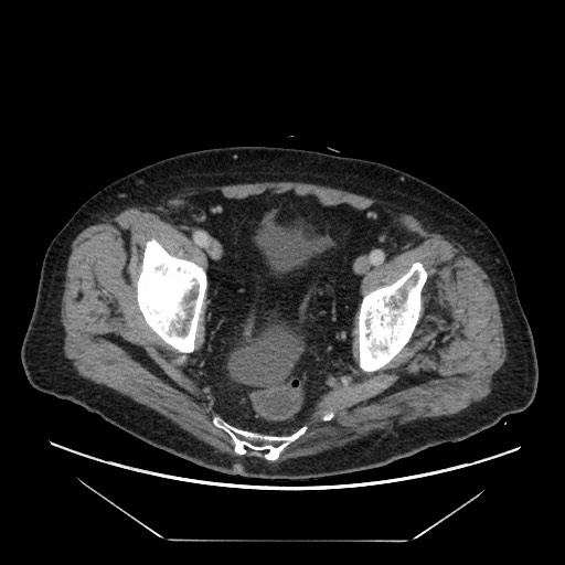 Cecal adenocarcinoma (Radiopaedia 64871-73817 A 85).jpg