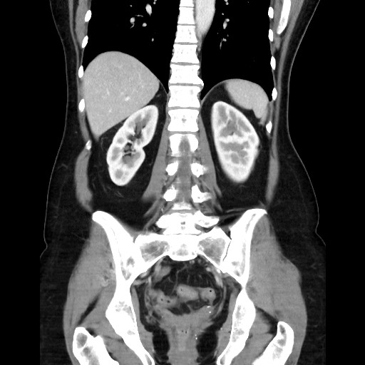 Cecal adenocarcinoma (Radiopaedia 75909-87331 B 35).jpg