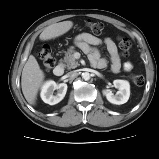 File:Cecal mass causing appendicitis (Radiopaedia 59207-66531 A 32).jpg
