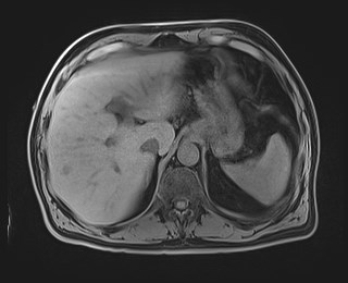 Cecal mass causing appendicitis (Radiopaedia 59207-66532 Axial T1 33).jpg
