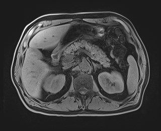 Cecal mass causing appendicitis (Radiopaedia 59207-66532 Axial T1 47).jpg
