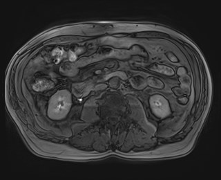 File:Cecal mass causing appendicitis (Radiopaedia 59207-66532 K 69).jpg