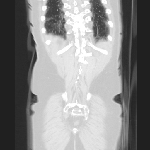 Cecal volvulus (Radiopaedia 75378-86620 Coronal lung window 117).jpg