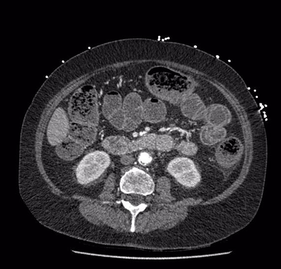 Celiac artery severe stenosis and dissection (Radiopaedia 44128-47842 B 47).jpg
