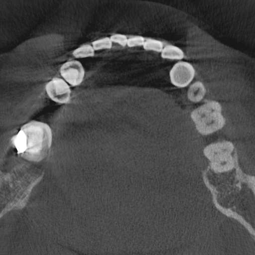 Cemento-osseous dysplasia (Radiopaedia 48251-53126 Axial non-contrast 59).jpg