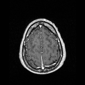 Central-variant posterior reversible encephalopathy syndrome (PRES) (Radiopaedia 43880-47358 Axial T1 C+ 146).jpg