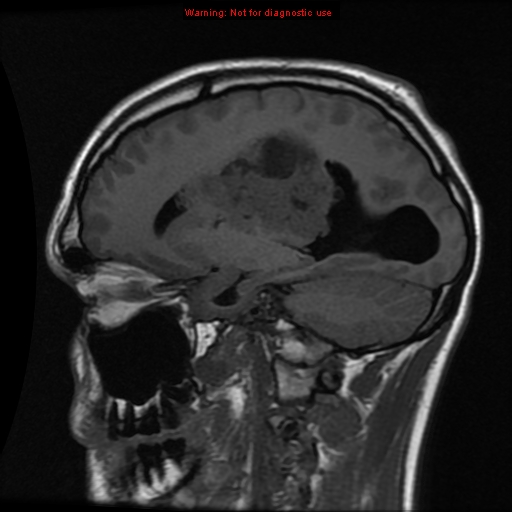File:Central neurocytoma (Radiopaedia 13188-13206 Sagittal T1 5).jpg