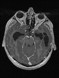 Central neurocytoma (Radiopaedia 56690-63469 Axial T1 C+ 57).jpg