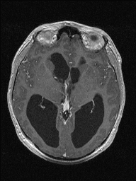 Central neurocytoma (Radiopaedia 56690-63469 Axial T1 C+ 75).jpg