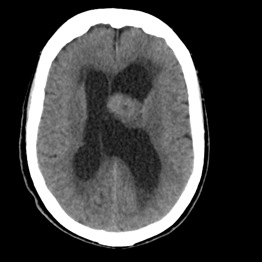 Central neurocytoma (Radiopaedia 65317-74346 Axial non-contrast 29).png