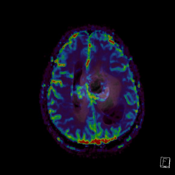 File:Central neurocytoma (Radiopaedia 84497-99872 Axial Perfusion 100).jpg