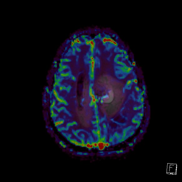 Central neurocytoma (Radiopaedia 84497-99872 Axial Perfusion 84).jpg