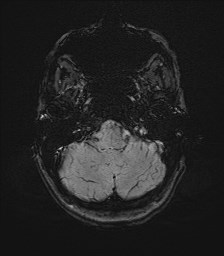 Central neurocytoma (Radiopaedia 84497-99872 Axial SWI 12).jpg
