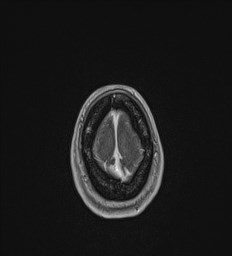 Central neurocytoma (Radiopaedia 84497-99872 Axial T1 C+ 142).jpg