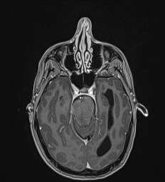 Central neurocytoma (Radiopaedia 84497-99872 Axial T1 C+ 54).jpg