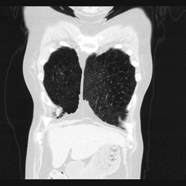 Centrilobular pulmonary emphysema (Radiopaedia 24495-24789 Coronal lung window 9).jpg