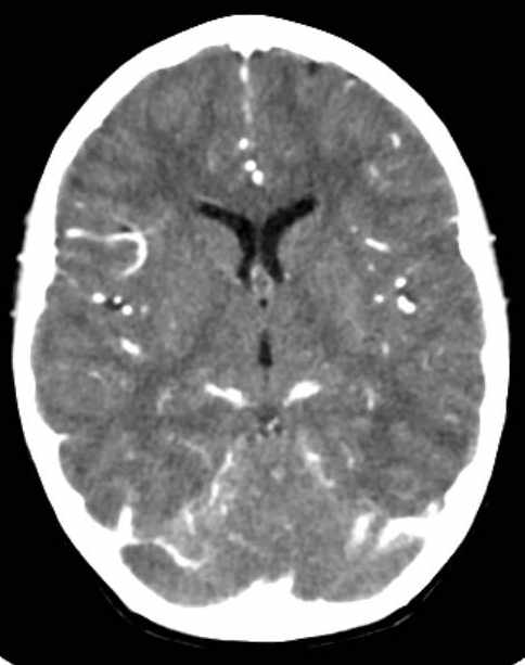 Cerebellar abscess (Radiopaedia 73727-84527 Axial C+ 40).jpg