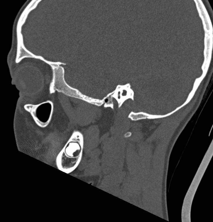 Cerebellar abscess (Radiopaedia 73727-84527 Sagittal bone window 8).jpg