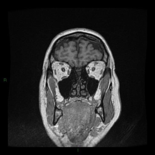File:Cerebellar abscess (Radiopaedia 78135-90678 Coronal T1 C+ 26).jpg