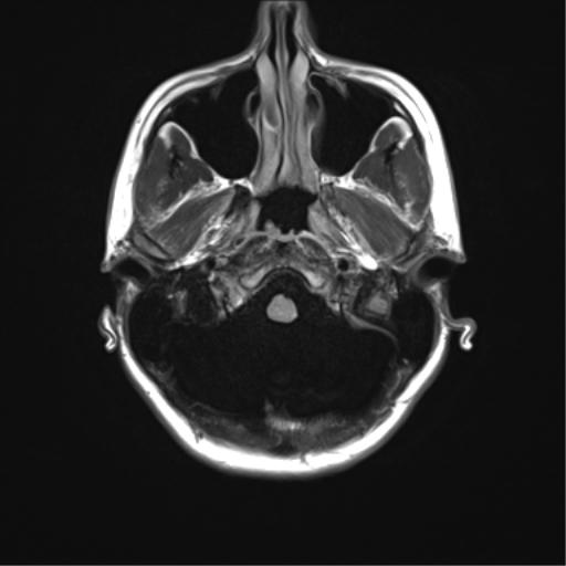 File:Cerebellar agenesis with hypoplastic pons (pontocerebellar hypoplasia) (Radiopaedia 57224-64138 Axial FLAIR 6).png