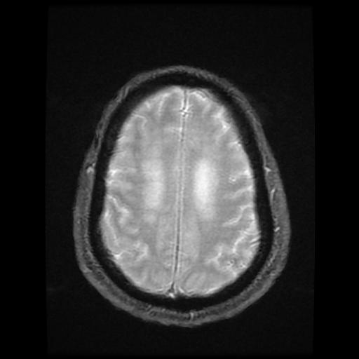 File:Cerebellar hemangioblastoma (Radiopaedia 88055-104622 Axial Gradient Echo 16).jpg