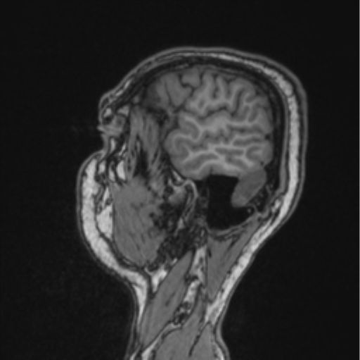 Cerebellar hemangioblastomas and pituitary adenoma (Radiopaedia 85490-101176 Sagittal T1 78).png