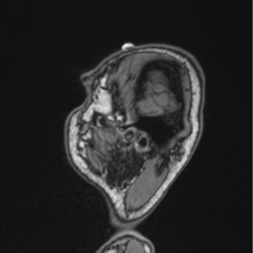 Cerebellar hemangioblastomas and pituitary adenoma (Radiopaedia 85490-101176 Sagittal T1 83).png