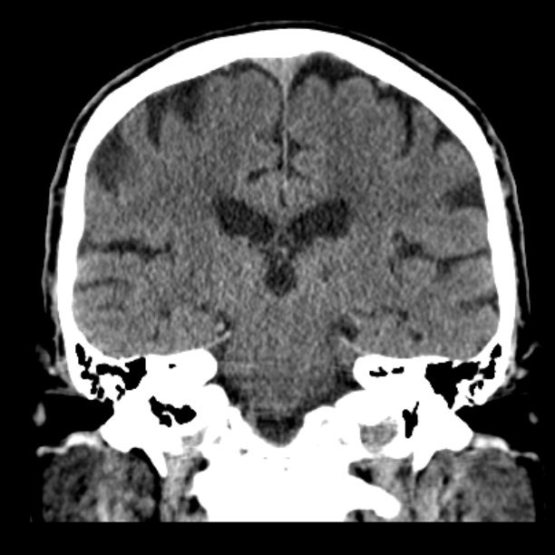 Cerebellar hemorrhage (Radiopaedia 27193-27359 Coronal non-contrast 34).jpg
