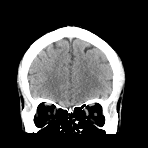 File:Cerebellar hemorrhage (Radiopaedia 37000-38669 Coronal non-contrast 12).png