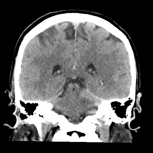 File:Cerebellar hemorrhage (Radiopaedia 37000-38669 Coronal non-contrast 30).png