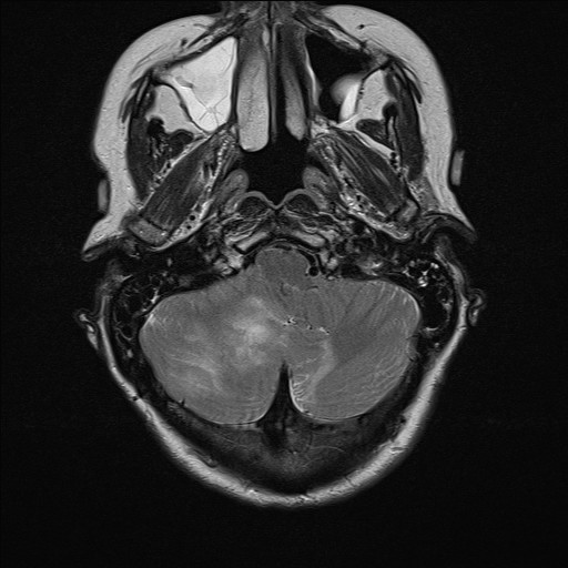 File:Cerebellar metastases (Radiopaedia 24038-24249 Axial T2 14).jpg
