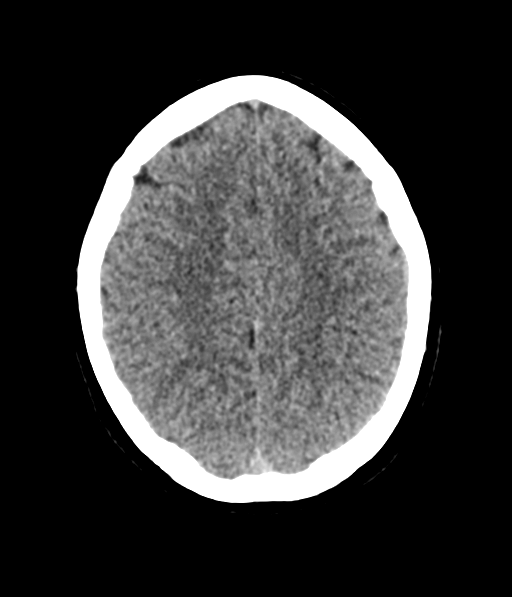 Cerebellar metastases - colorectal adenocarcinoma (Radiopaedia 40947-43652 Axial non-contrast 49).png