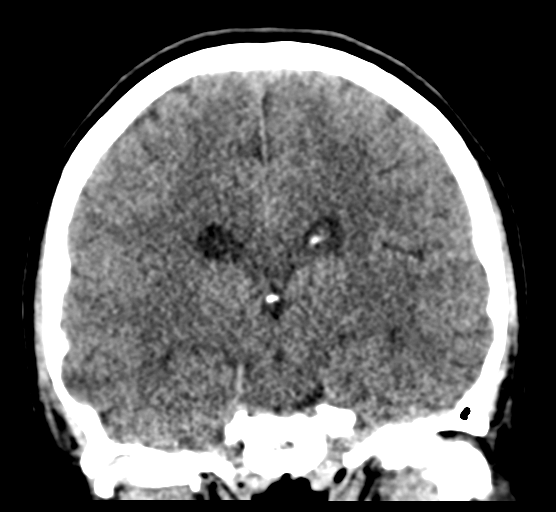 Cerebellar metastases - colorectal adenocarcinoma (Radiopaedia 40947-43652 Coronal non-contrast 54).png