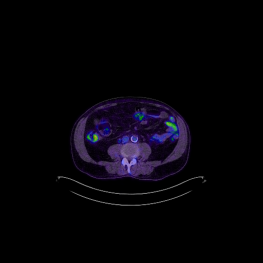 Cerebellar metastasis (Radiopaedia 33616-34719 A 70).png