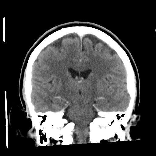 Cerebellar metastasis (cystic appearance) (Radiopaedia 41395-44258 D 35).png