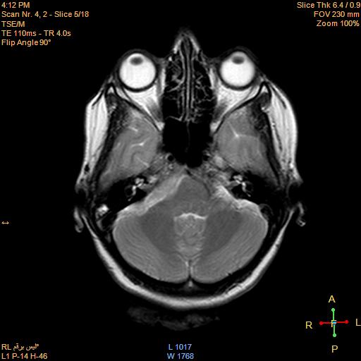 File:Cerebellopontine angle meningioma (Radiopaedia 22488-22525 Axial T2 3).jpg